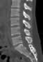 Level 3. CT of lumbar Spine, sagittal reconstruction